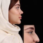 جراحی بینی5