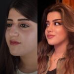 جراحی بینی4