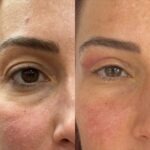 بلفاروپلاستی