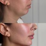 تزریق فیلر چانه