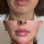 تزریق فیلر چانه