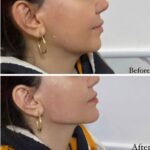 تزریق فیلر چانه