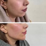 تزریق فیلر چانه