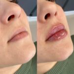 تزریق فیلر لب