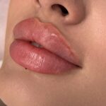 تزریق فیلر لب