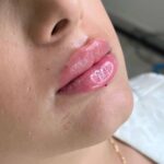 تزریق فیلر لب