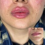 تزریق فیلر لب