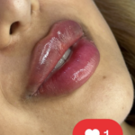 تزریق فیلر لب