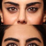 لیفت شقیقه و پیشانی