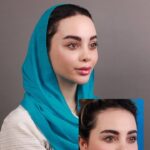 لیفت شقیقه و پیشانی