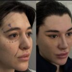 لیفت شقیقه و پیشانی